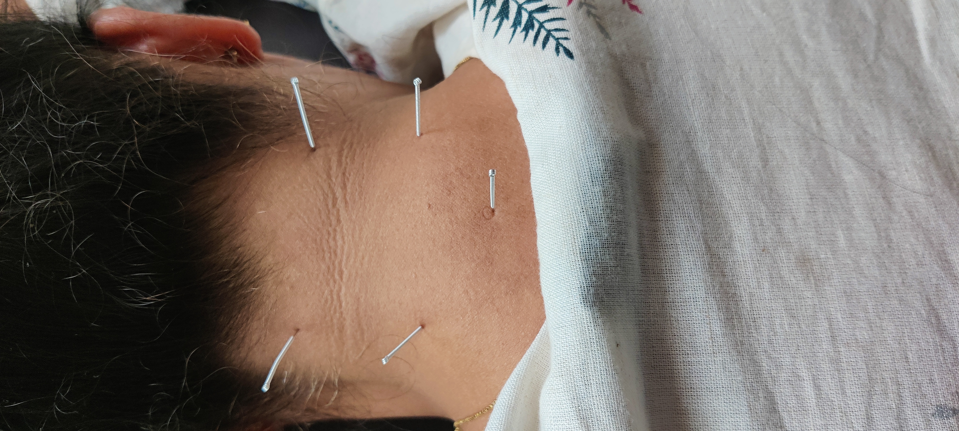 Dry Needling