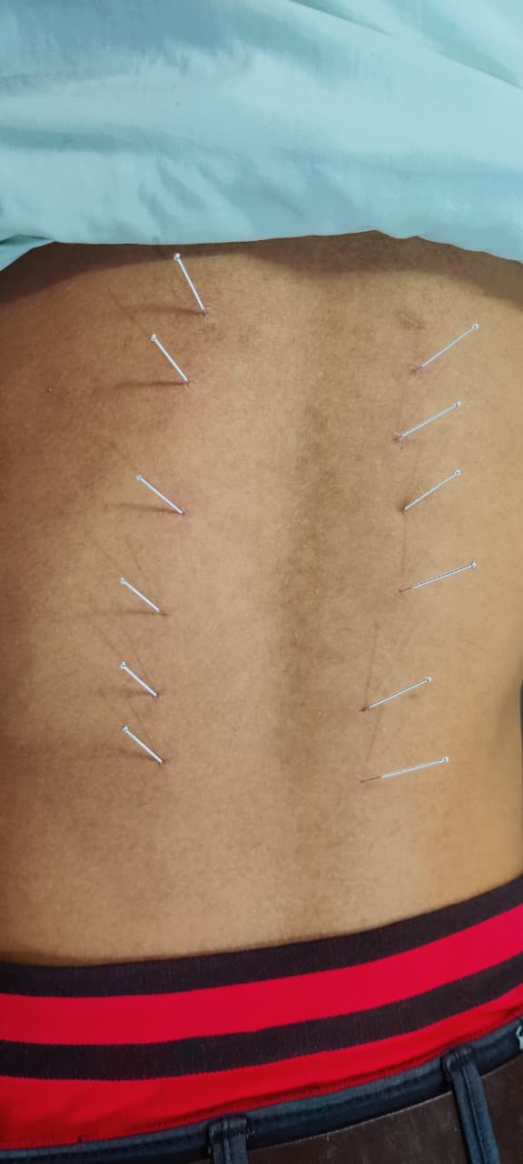 Dry Needling Treatment